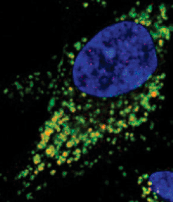 Imagen: Microscopía confocal de una célula con lisosomas (verdes) con beta-amiloide acumulado (rojo) (Fotografía cortesía de la Universidad Linköping).